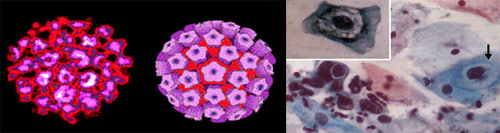 İnsan papilloma virusları – İPV, Human papillomavirus – HPV